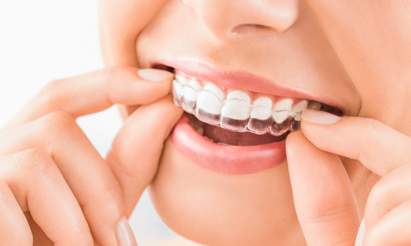 How to get the best from Invisalign treatment